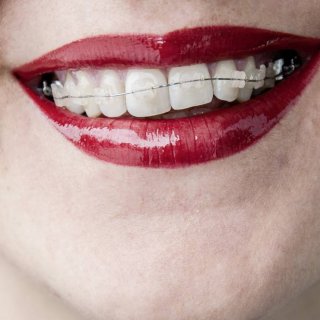 Wer Zähneputzen mit Zahnspange ernst nimmt, braucht sein Lächeln nicht zu verstecken.