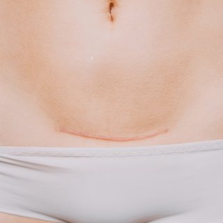 Unterkörper einer Frau mit Slip und Kaiserschnittnarbe