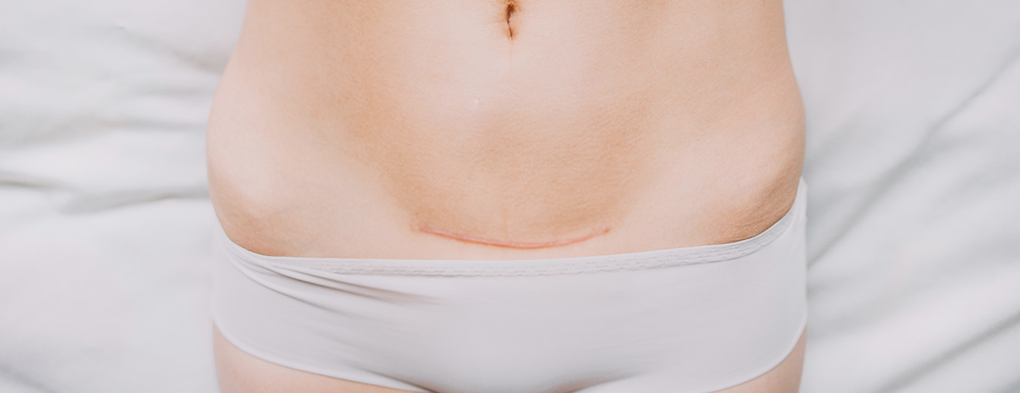 Unterkörper einer Frau mit Slip und Kaiserschnittnarbe